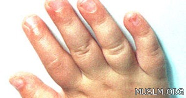   7reasons of water retention in the body 