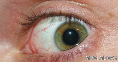 5 home remedies can save you from the problem of dry eye