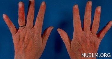 First aid for electrical burns