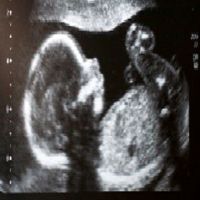  10 signs warn you of the importance of screening sonar to make sure the health of the fetus 