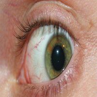 5 home remedies can save you from the problem of dry eye